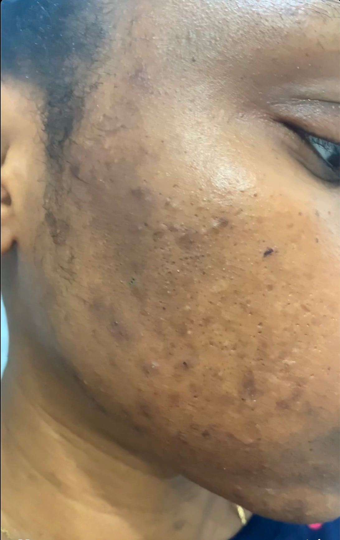 Hyperpigmentation