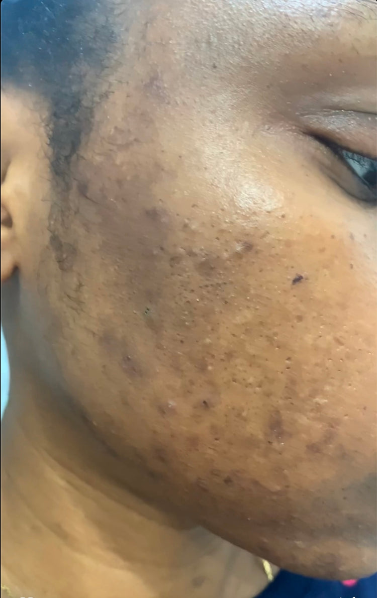 Hyperpigmentation