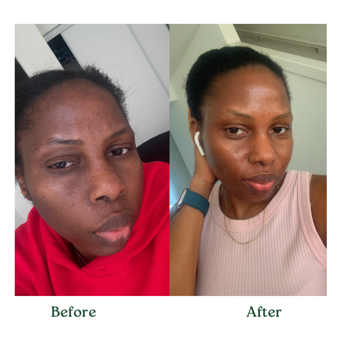 Before and after results using Blemish Control Bundle for clear and radiant skin transformation.