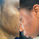 Before and after comparison of skin showing reduction in dark spots using Hyperpigmentation Set